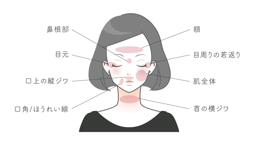 ベビーコラーゲンの注入部位