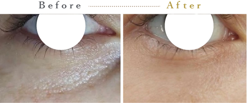 プルリアルシルク症例2