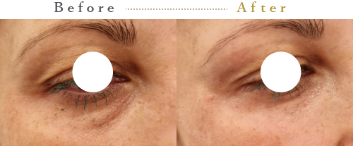 プルリアルシルク症例3