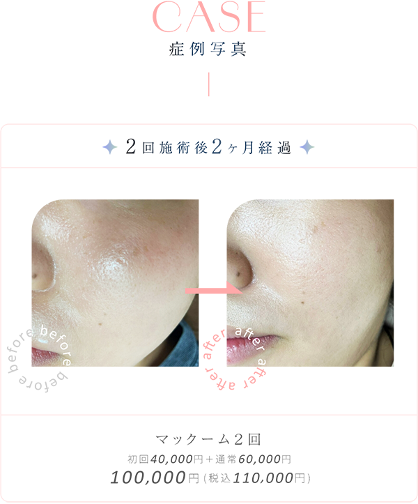 ドラッグデリバリーシステム CP25の症例写真