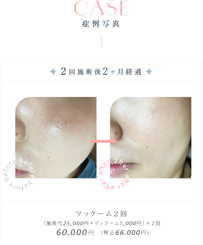 ドラッグデリバリーシステム CP25の症例写真