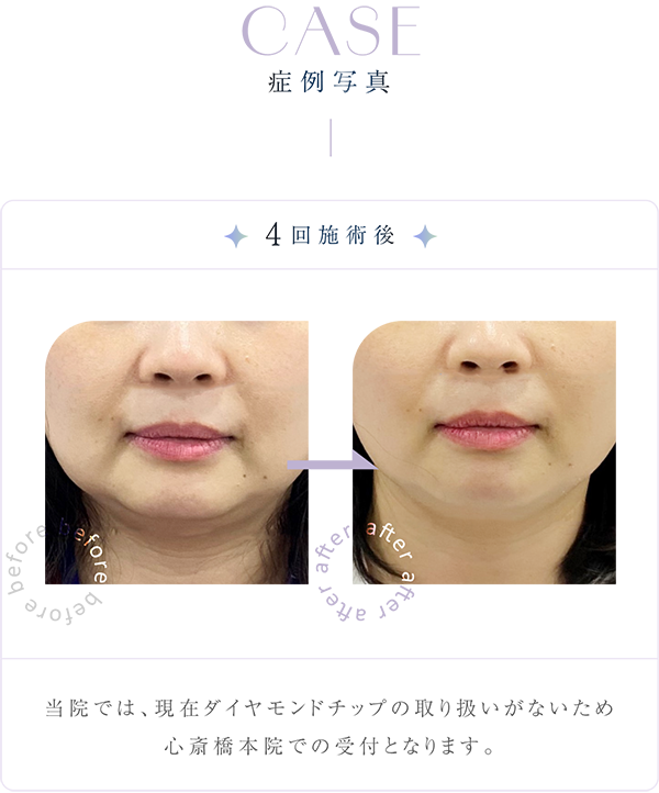 ダイヤモンドチップの症例写真