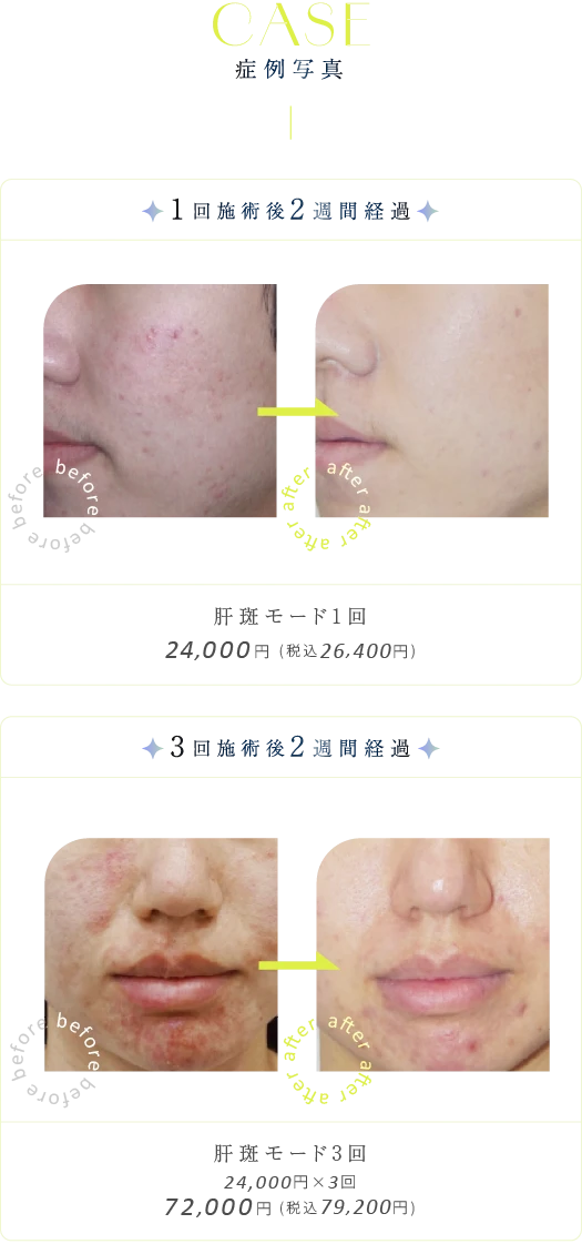 肝斑モード S-16の症例写真